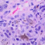histopathology of invasive melanoma, high magnification