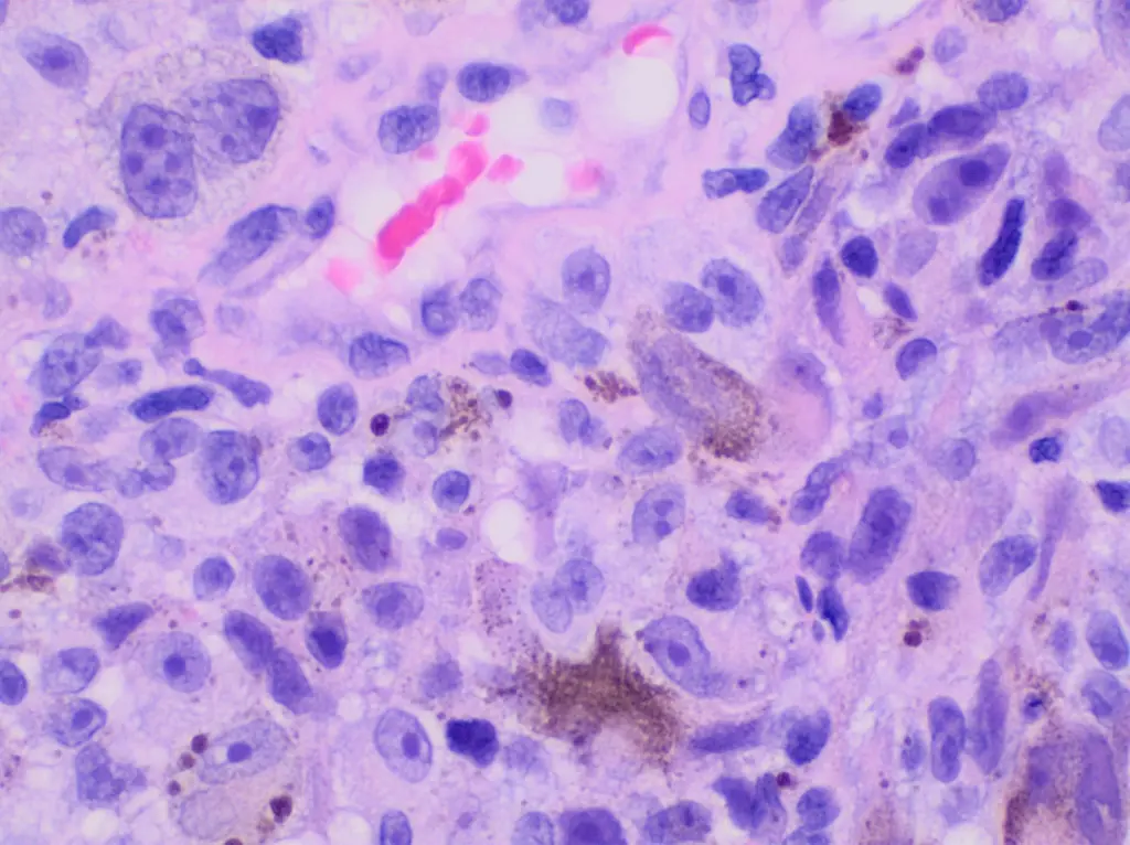 histopathology of invasive melanoma, high magnification